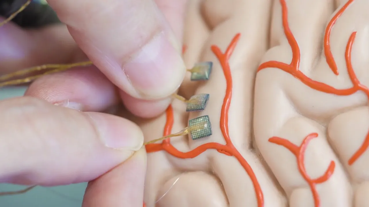Revolução Médica: Sistema de Dupla Bypass Neural Restaura Movimento e Sensação em Pacientes com Paralisia